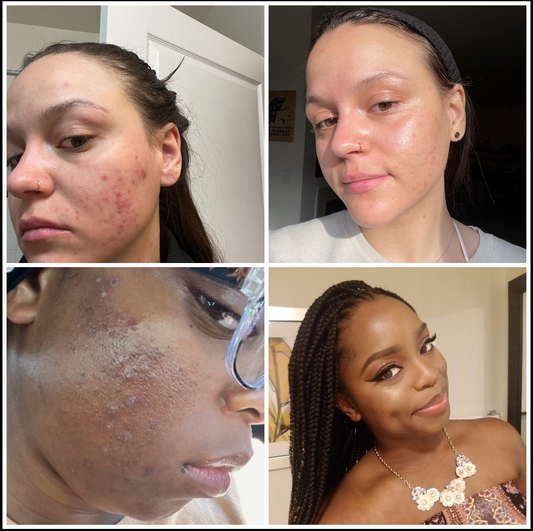 Clear Skin, Clear Mind: The Best Organic Products and Natural Acne Remedies.