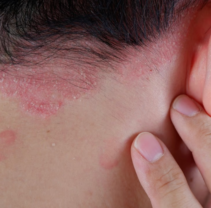 Eczema bumps deals